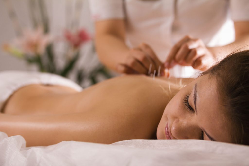 lady receiving acupuncture